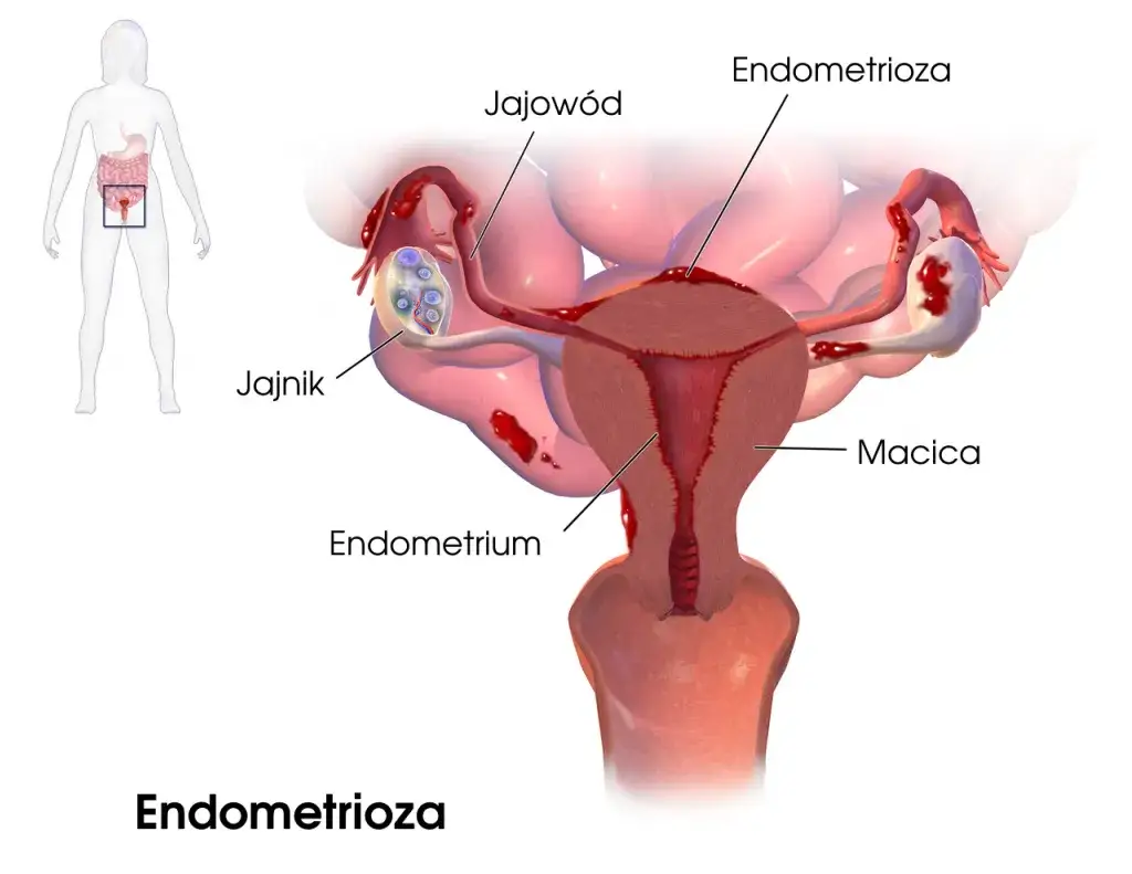 Kobieta z bólem miednicy, schemat endometriozy
