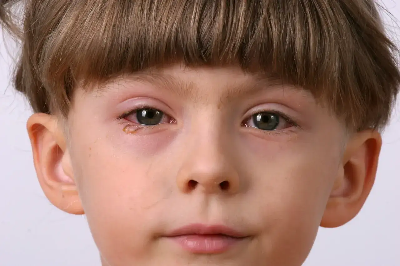 Primo piano di un bambino con occhi arrossati e lacrimanti, tipici della congiuntivite nei bambini.