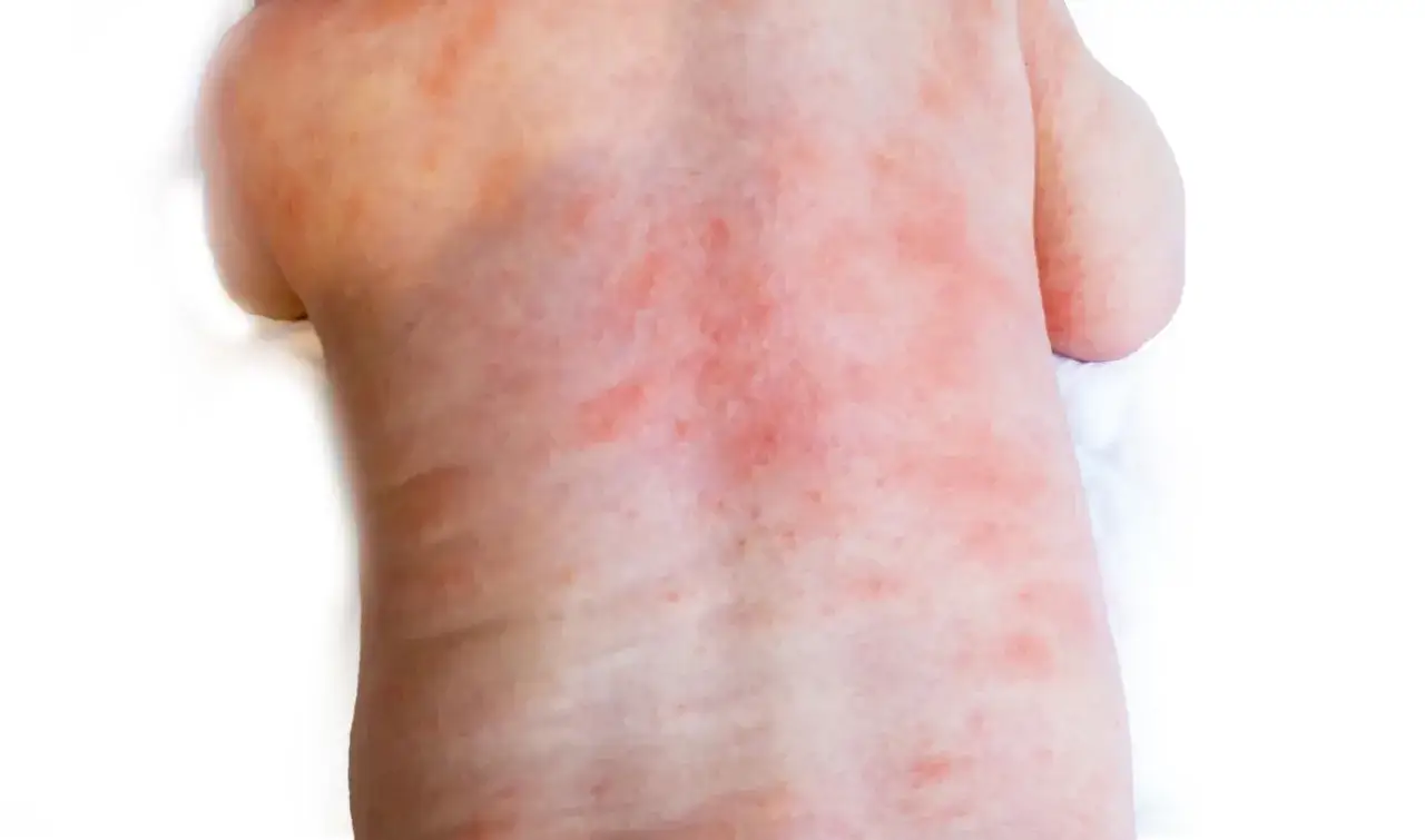 Le dos d'un nourrisson pr&eacute;sente un bouton rouge diffus, signe d'une irritation cutan&eacute;e.