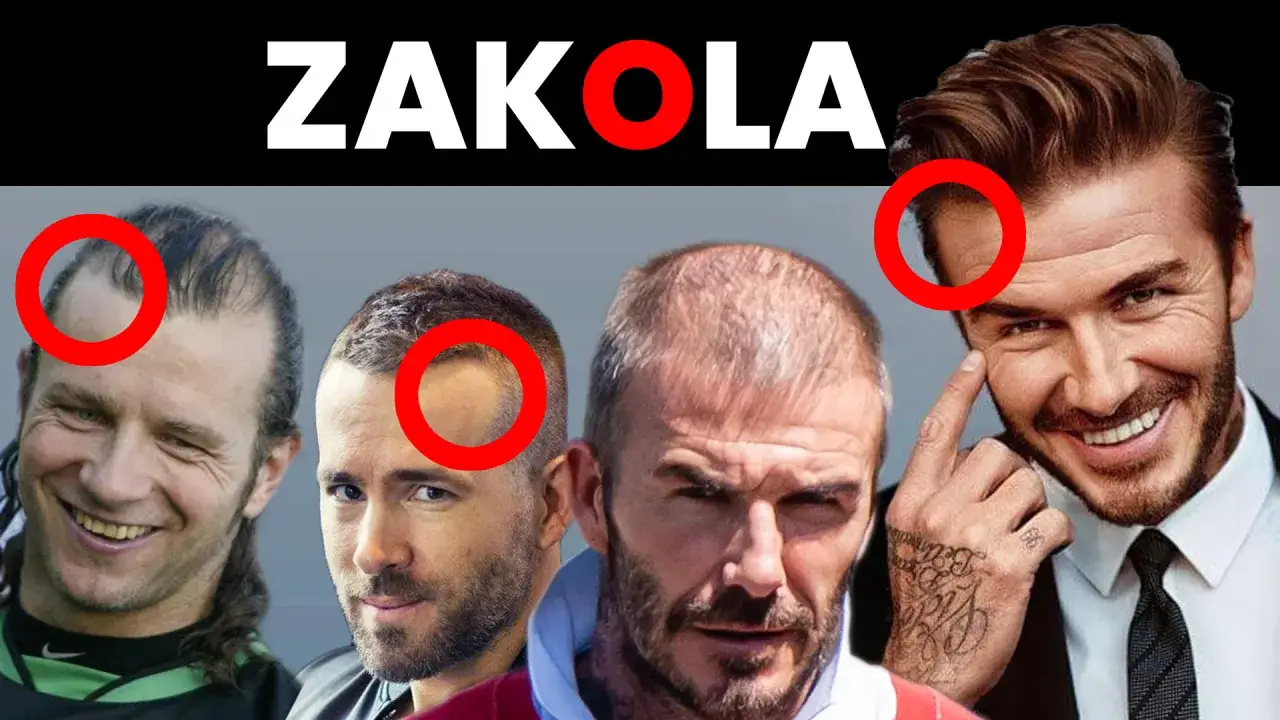 Czterech mężczyzn z widocznymi zakolami, zaznaczonymi czerwonymi okręgami. Temat: zakola u mężczyzn.