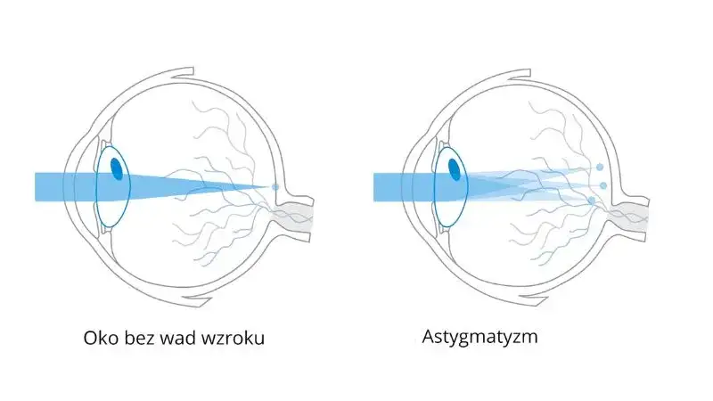 oko astygmatyzm schemat