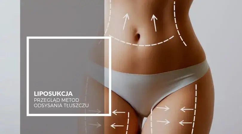 mapa ciała, gdzie odkłada się tłuszcz po liposukcji, obszary kompensacji