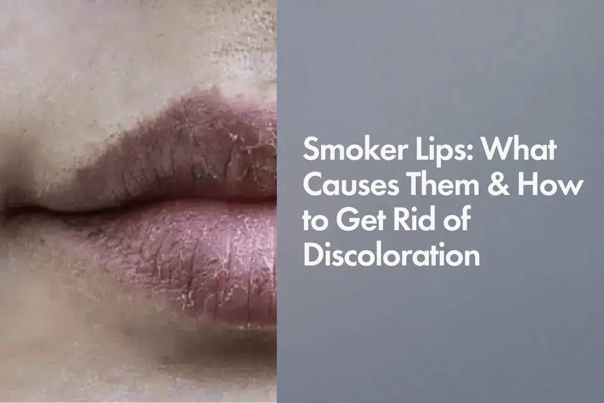 Labios con manchas por fumar, mostrando sequedad y decoloración.