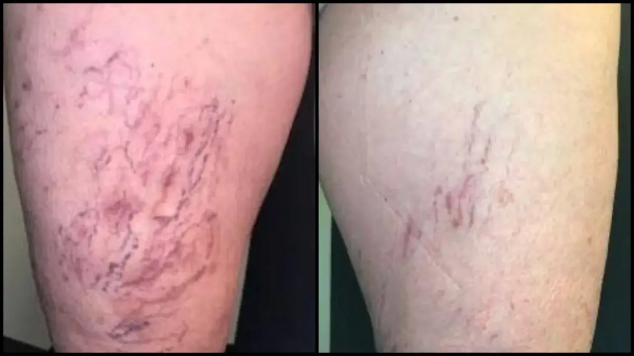 Przed i po laserowym zamykaniu naczynek na twarzy. Widoczne zmniejszenie widoczności pajęczków naczyniowych, bez znaczących skutków ubocznych.