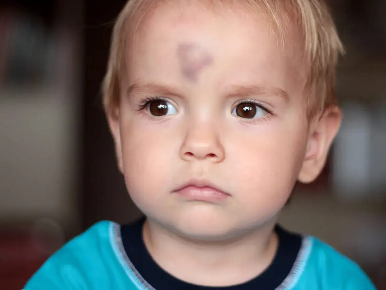 Bambino con livido sulla fronte, possibile trauma cranico.