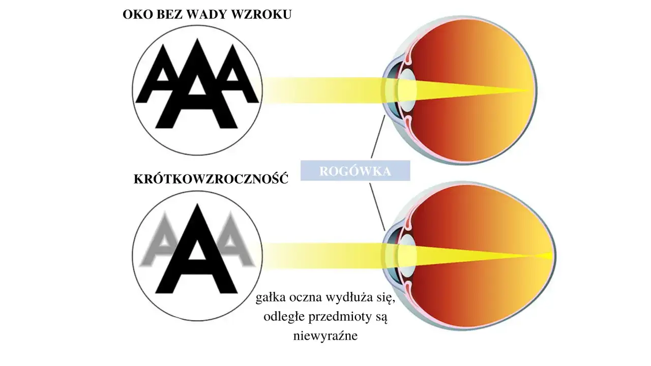 Oko z wadą wzroku minus (krótkowzroczność) sprawia, że odległe przedmioty są niewyraźne, bo gałka oczna się wydłuża.