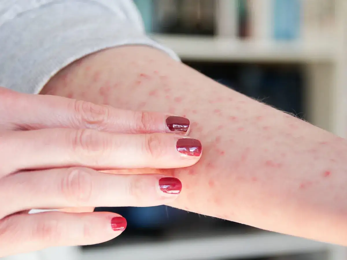 En arm med m&aring;nga sm&aring;, r&ouml;da prickar. En hand med m&ouml;rkr&ouml;tt nagellack unders&ouml;ker huden.