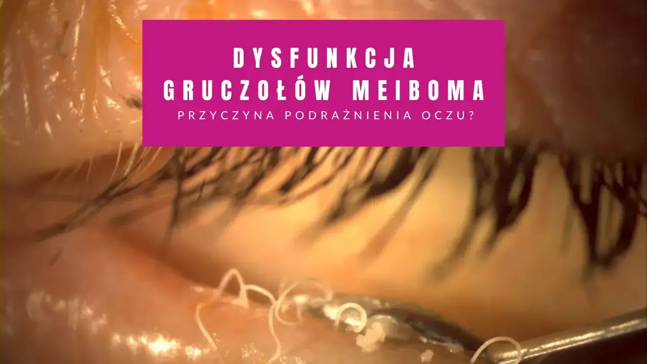 Dysfunkcja gruczołów Meiboma może powodować podrażnienie oka. Widoczne są drobne pasożyty na powiece.