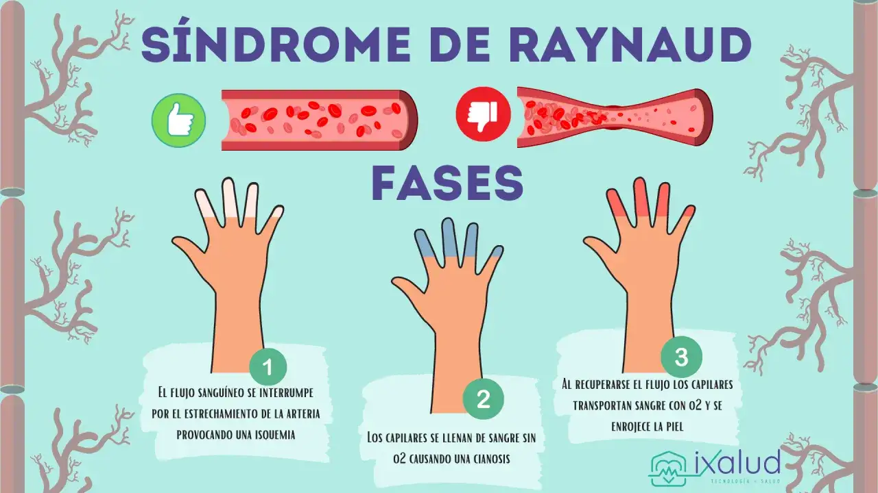 Ilustraci&oacute;n del s&iacute;ndrome de Raynaud: manos con dedos fr&iacute;os y p&aacute;lidos, luego azulados y finalmente enrojecidos, mostrando las fases de la enfermedad.