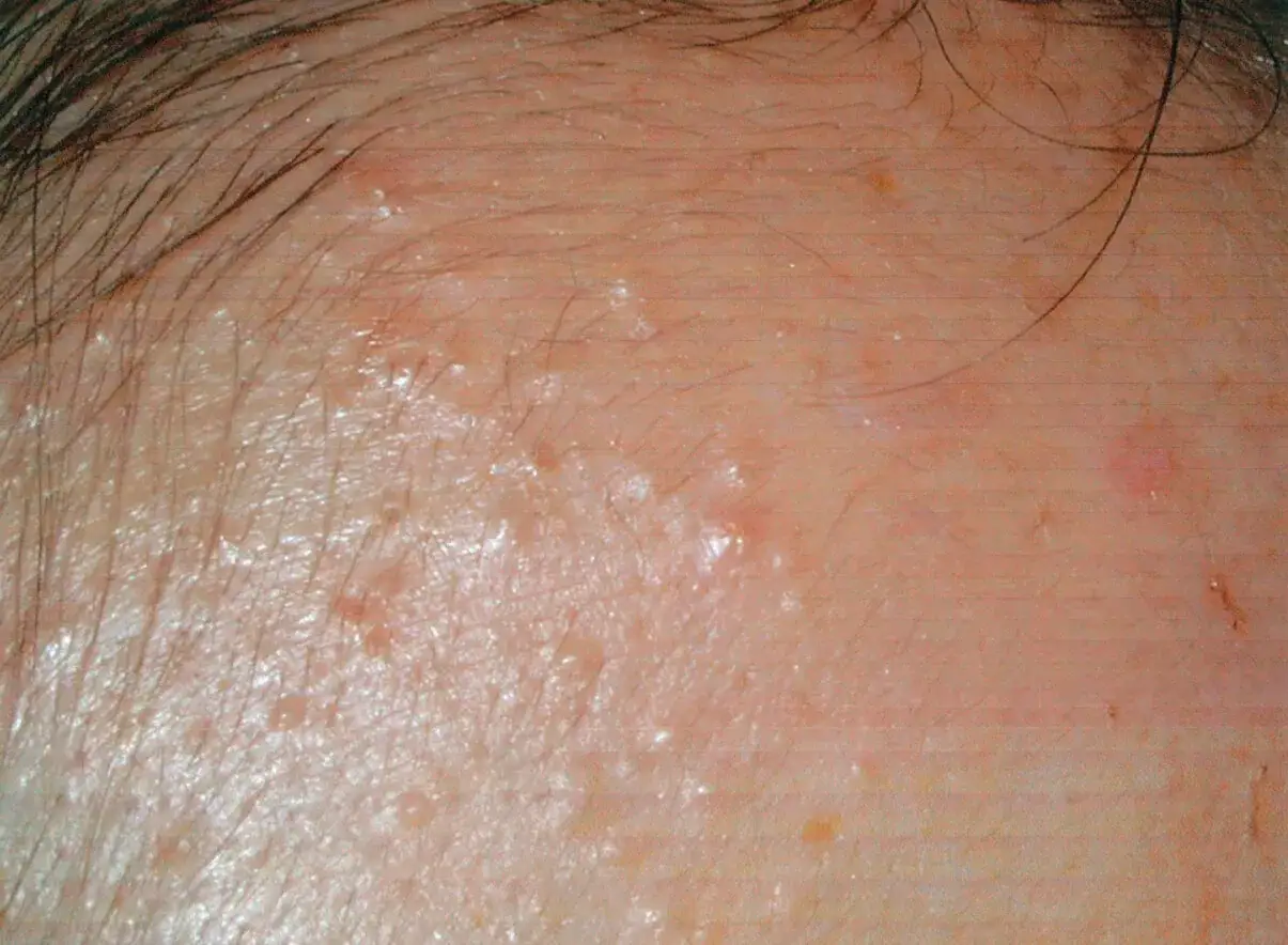 Piel con pequeños bultos blancos y rojizos, indicativos de posible acne fungico.