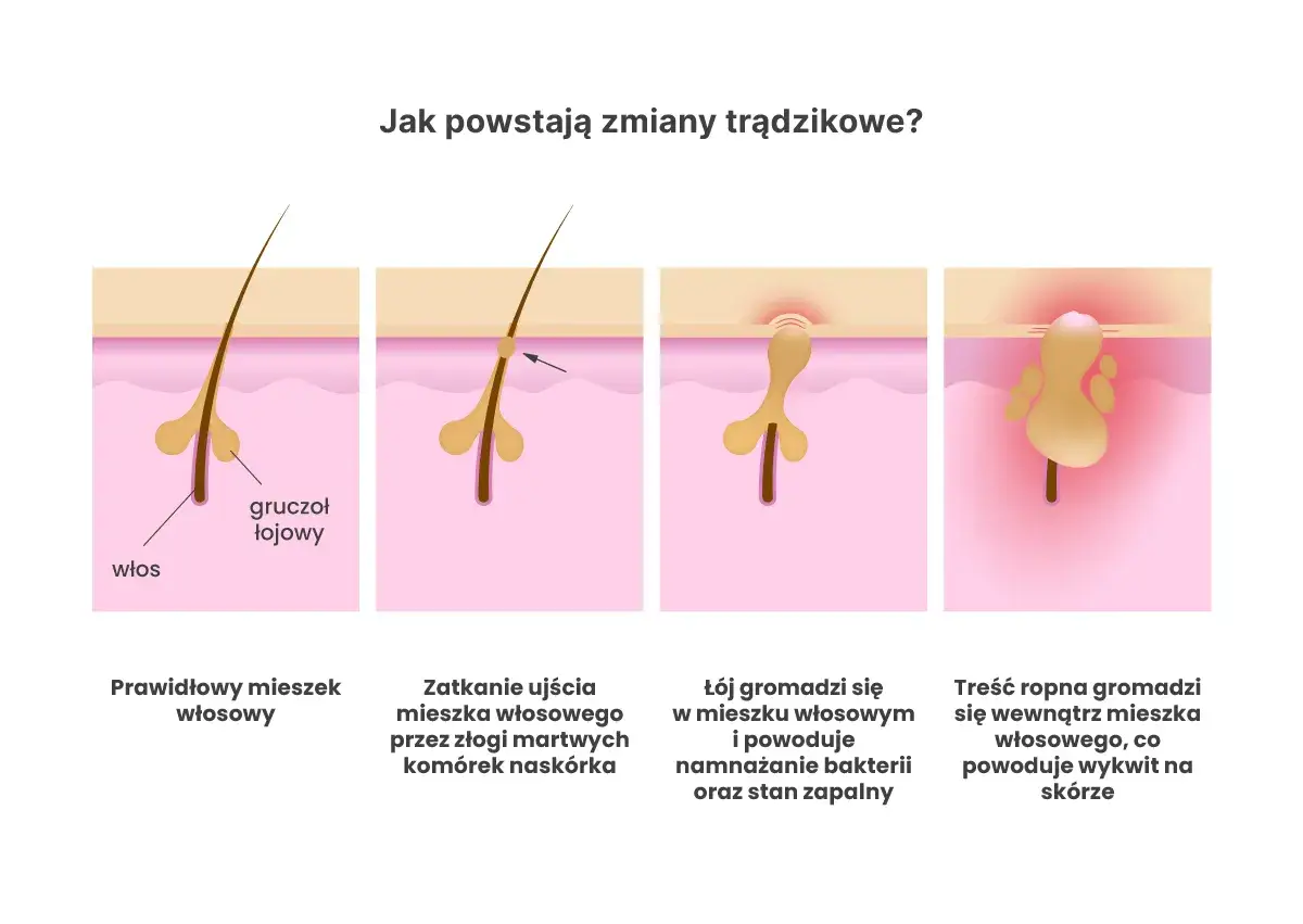 Ilustracja pokazuje powstawanie zmian trądzikowych, od zatkanego mieszka włosowego po ropny wykwit. Poznaj domowe sposoby na trądzik młodzieńczy.