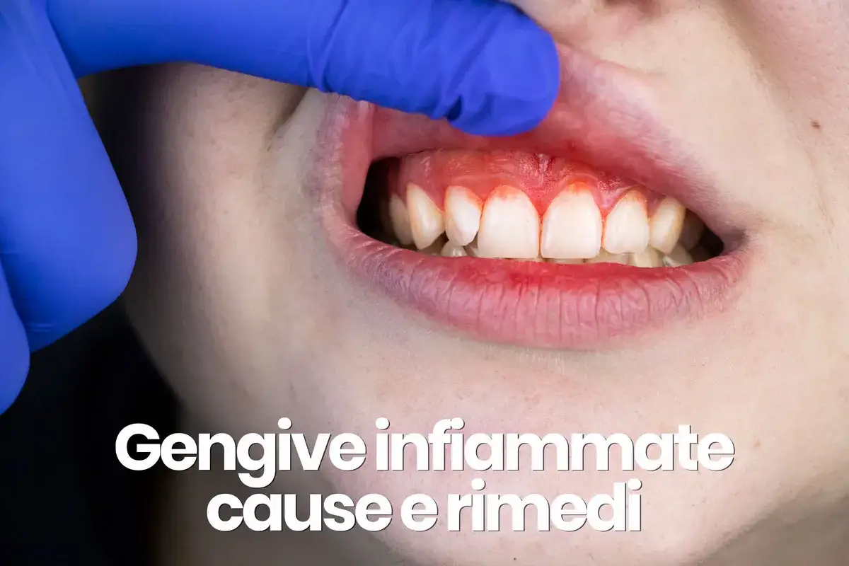Gengive rosse e gonfie, un segno di gengivite da stress. Denti bianchi visibili, con un dito guantato che solleva il labbro.