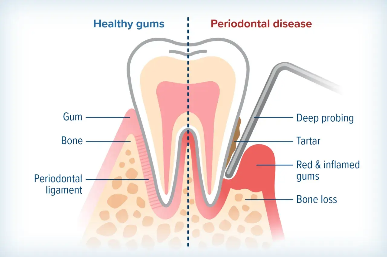 Ilustracja pokazuje, czym jest periodontologia: zdrowe dziąsła vs. choroba przyzębia, z zaznaczonym zapaleniem, kamieniem i utratą kości.