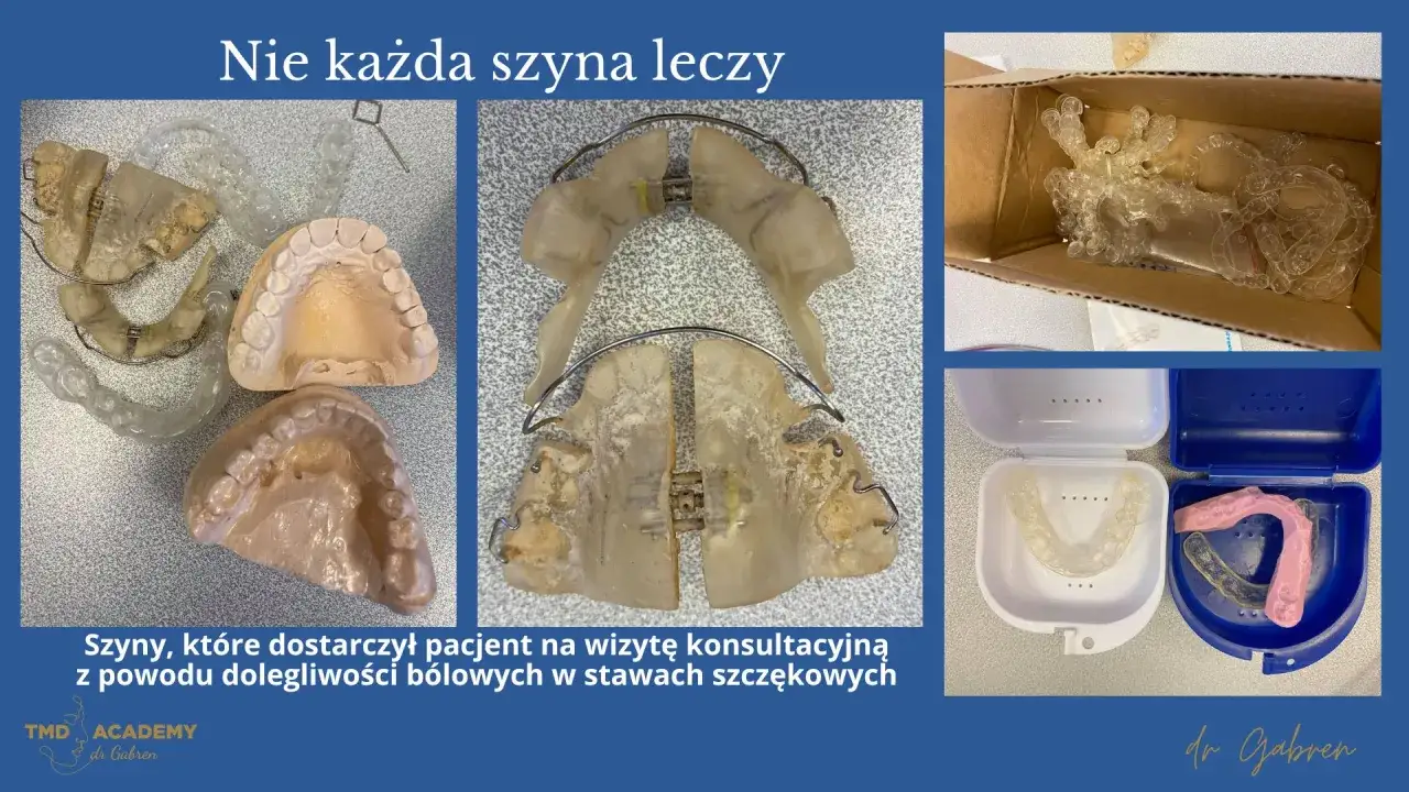 Różne szyny, niektóre zużyte, inne nowe, pokazują złożoność szynoterapii. Pacjent przyniósł je z powodu bólu szczęki.