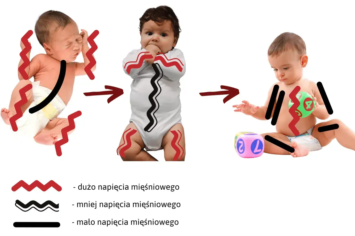 Zmiana wzmożonego napięcia mięśniowego u niemowląt dzięki ćwiczeniom. Od wysokiego napięcia do swobodnych ruchów.