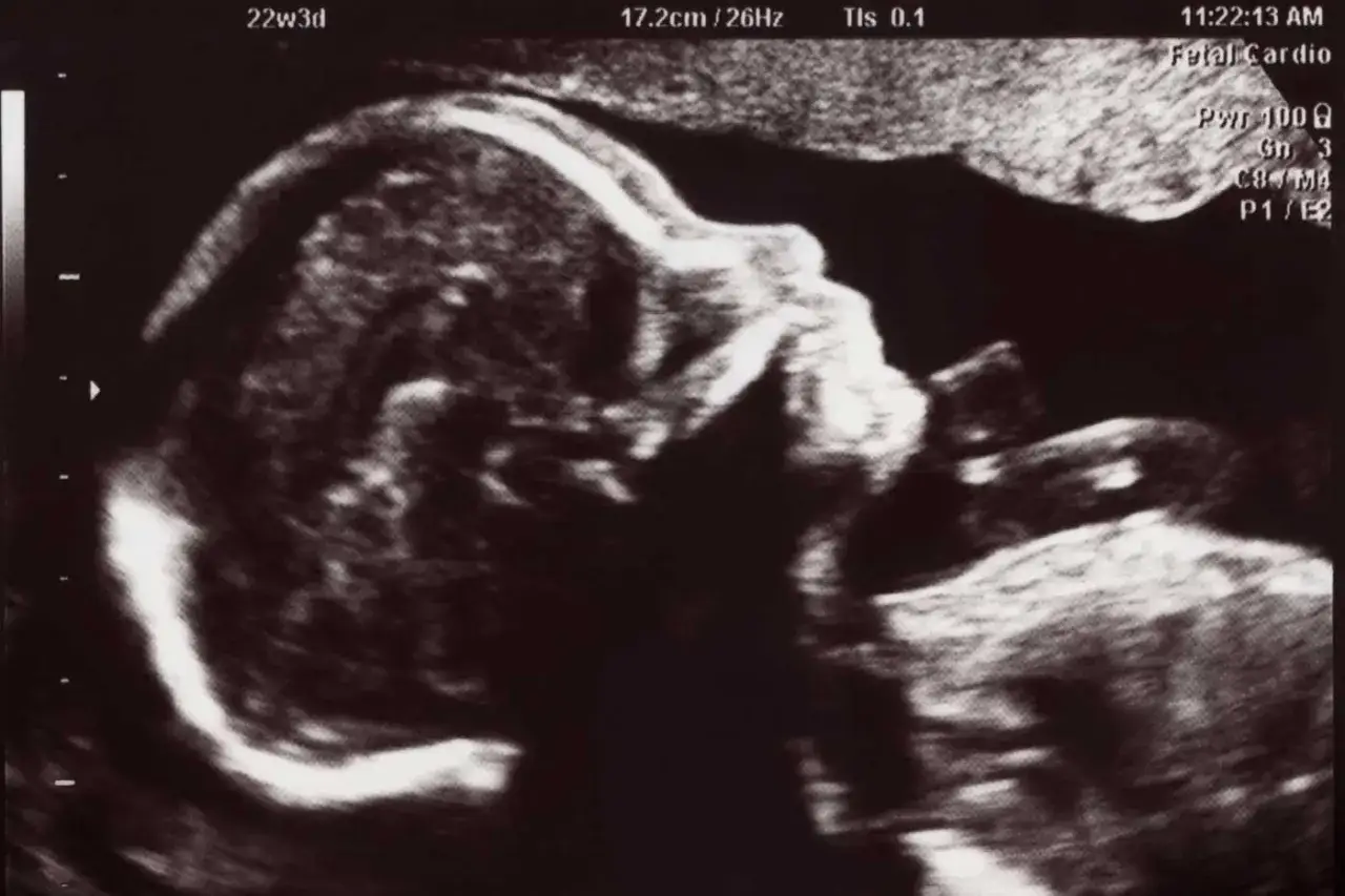 Ultraschallbild eines Babys in der 22. SSW. Das Gesichtsprofil ist deutlich erkennbar, mit einer kleinen Nase und einem Mund.