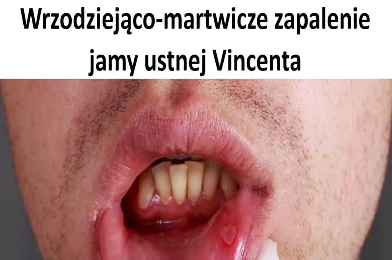 Otwarta jama ustna z widocznym owrzodzeniem na wardze. Okopowe usta Vincenta, bolesne i zapalne.
