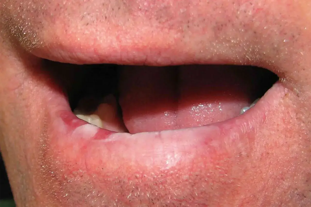 Leucoplachia labbra: aree biancastre e ispessite sul labbro inferiore, con rossore circostante.