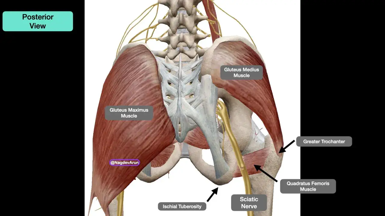 Vista posterior de la pelvis y gl&uacute;teos, mostrando el nervio ci&aacute;tico y m&uacute;sculos. Podr&iacute;a indicar dolor gl&uacute;teo izquierdo.