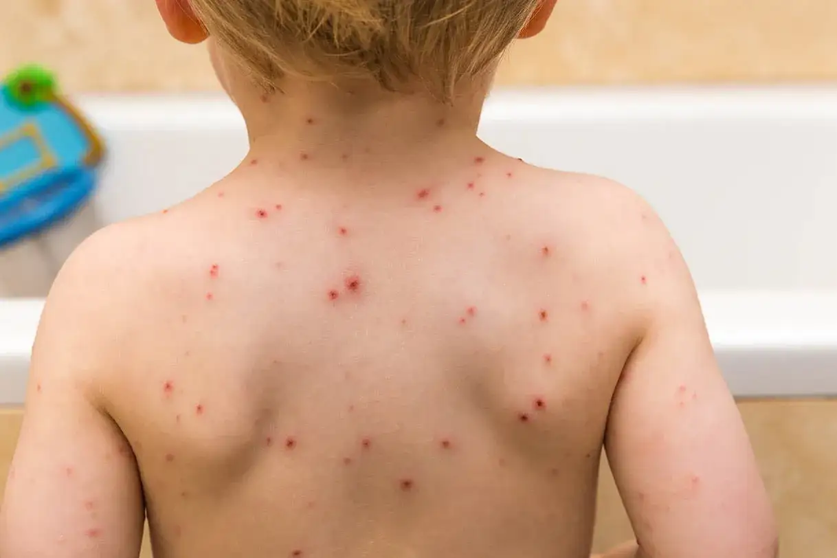 Enfant avec le dos couvert de boutons de varicelle. Conseils pour savoir comment faire sécher les boutons de varicelle rapidement.