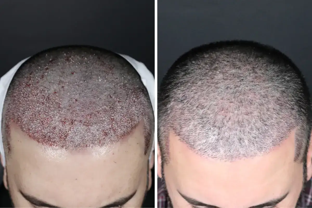 Antes y después de un trasplante capilar. La imagen izquierda muestra el cuero cabelludo con injertos y signos de shock loss. La derecha, un resultado con cabello más denso.