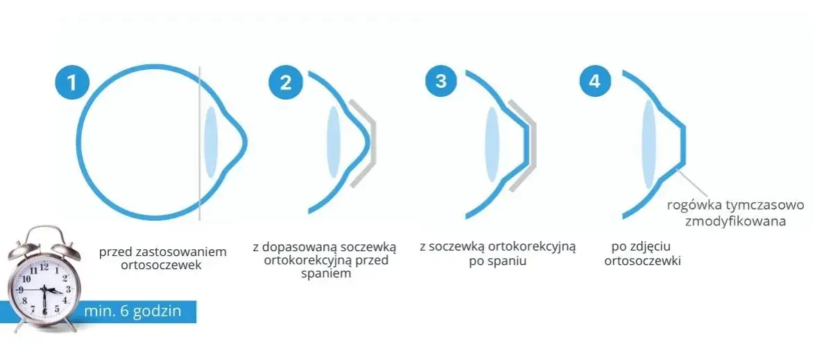 soczewki ortokorekcyjne na oku