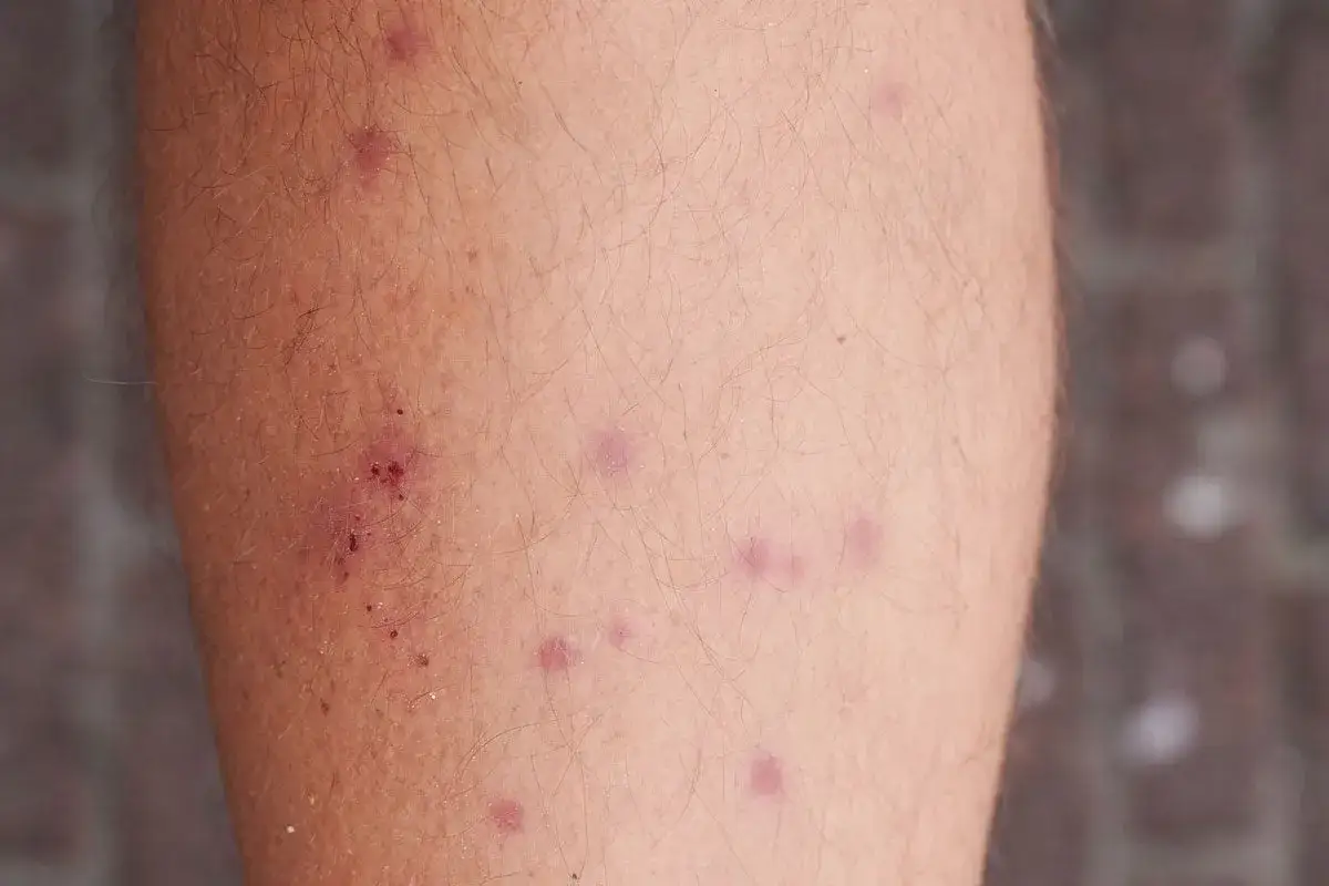 Pelle con molte punture di acaro, alcune arrossate e leggermente sanguinanti, altre più discrete.