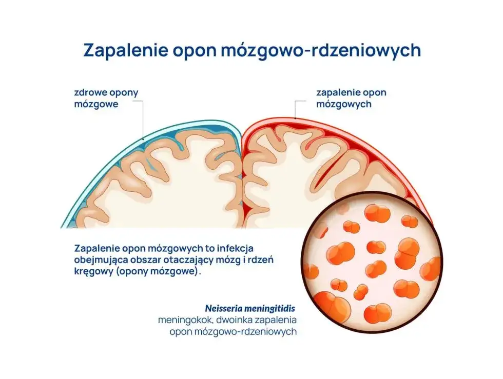 Objawy zapalenia opon mózgowych u niemowląt ciemiączko