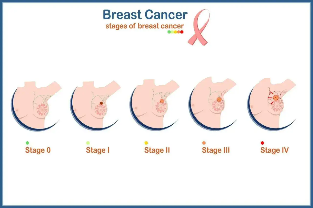 Brustkrebs-Stadien von 0 bis IV, die die Entwicklung und Ausbreitung des Tumors zeigen. Früherkennung ist entscheidend für die Brustkrebs prognose.