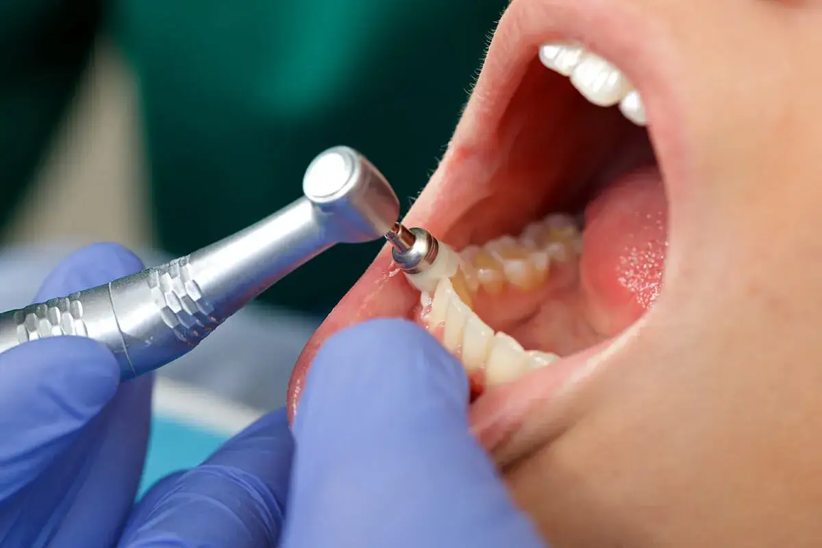 Dentysta poleruje zęby, szukając domowych sposobów na ruszające się zęby.