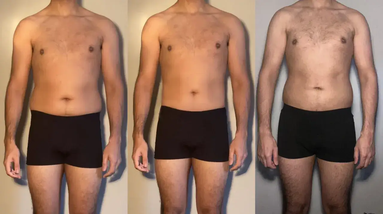 Före- och efterbilder av en man som genomgått vaser liposuction. Synlig minskning av fett runt midjan.