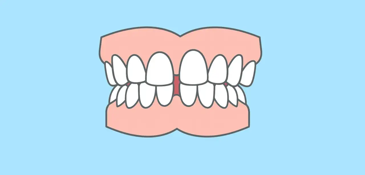 En illustration av tänder med ett tydligt diastema mediale, ett mellanrum mellan framtänderna.