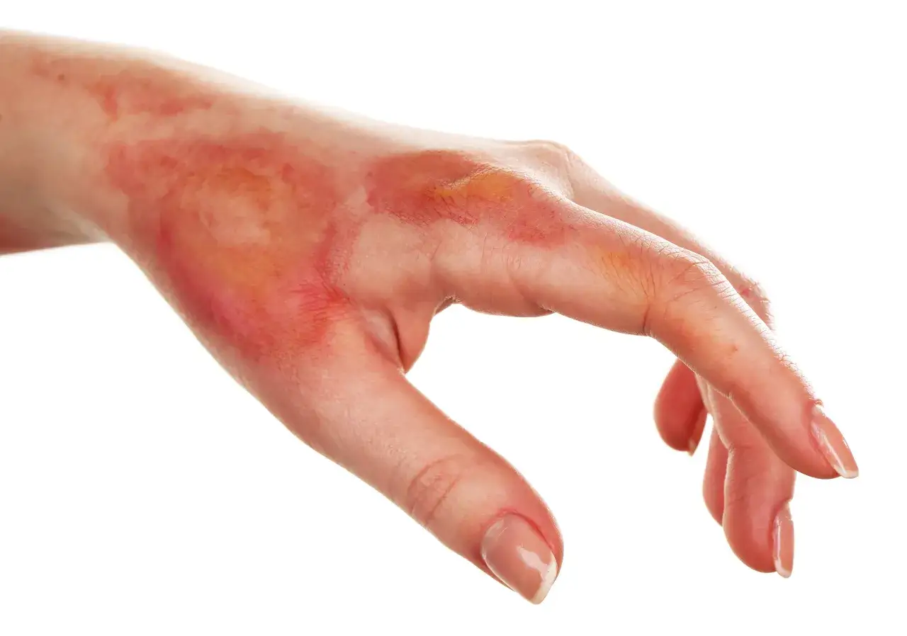 Main de femme avec une rougeur autour d'une brûlure, montrant des signes d'irritation cutanée.