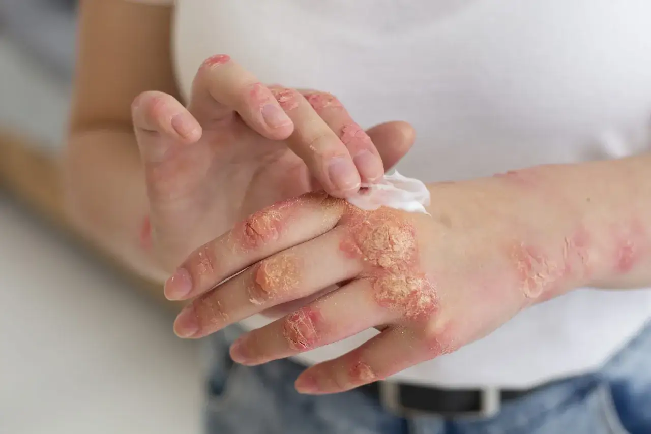 Manos con psoriasis, aplicando crema para aliviar la piel seca y escamosa.