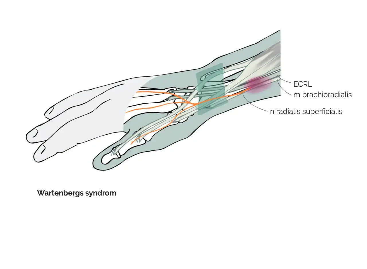 Illustration av Wartenbergs syndrom som visar nerver och muskler i handleden, där en kramp i handleden kan uppstå.