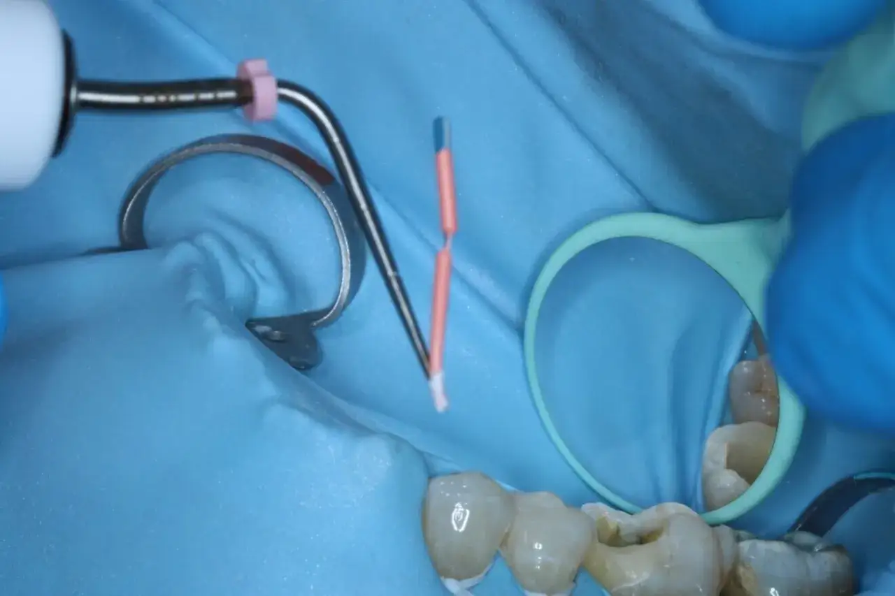 Zabieg endodoncji: narzędzia stomatologiczne przygotowane do leczenia kanałowego zęba.