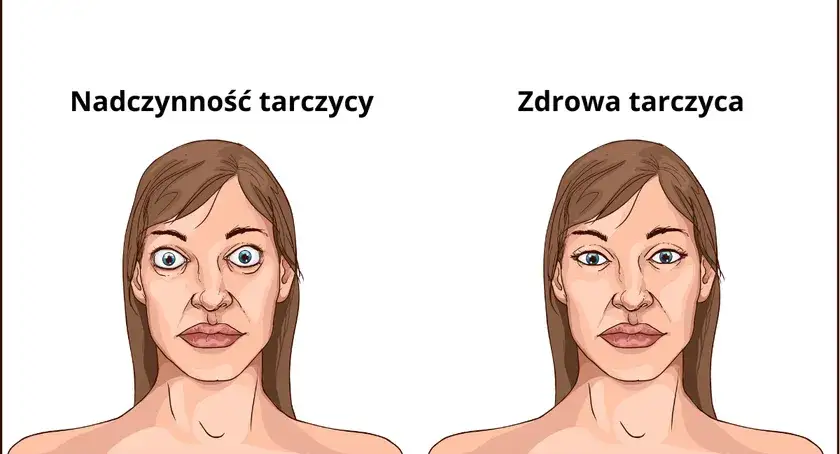 psychiczne objawy nadczynności tarczycy grafika