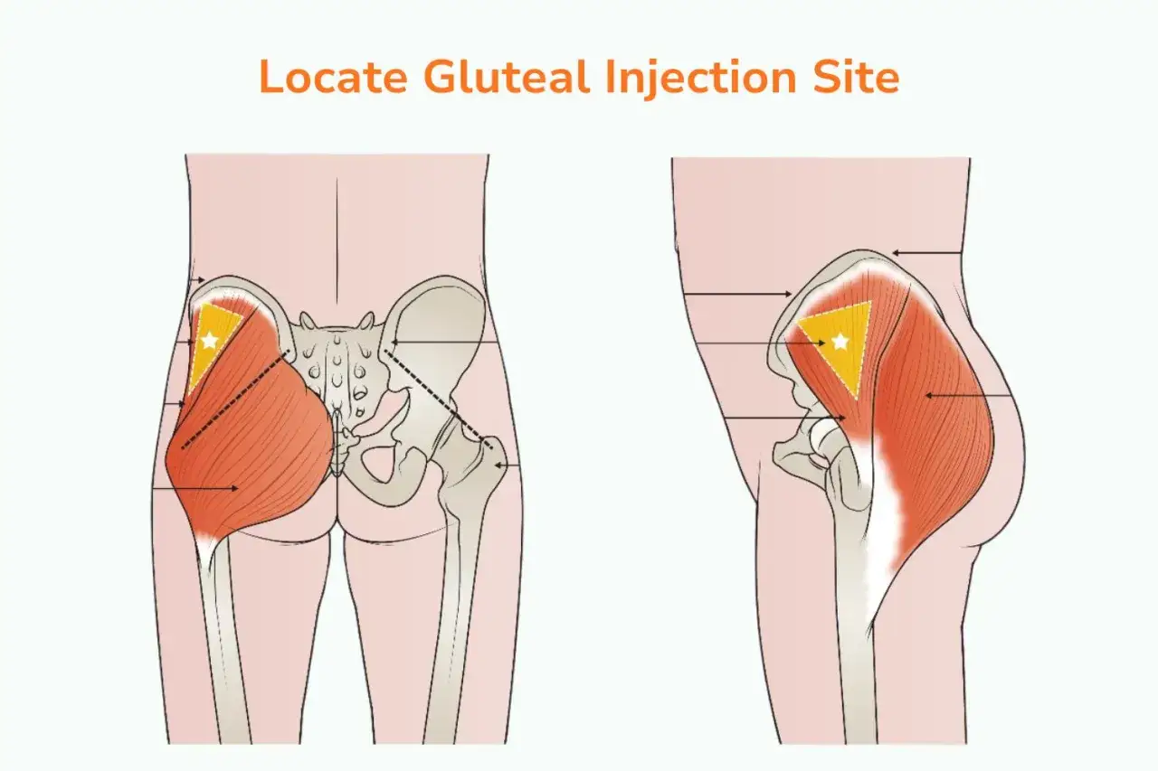Anatomical diagrams showing the gluteal muscles and pelvic bone, highlighting the correct site for a zastrzyk w pośladek.
