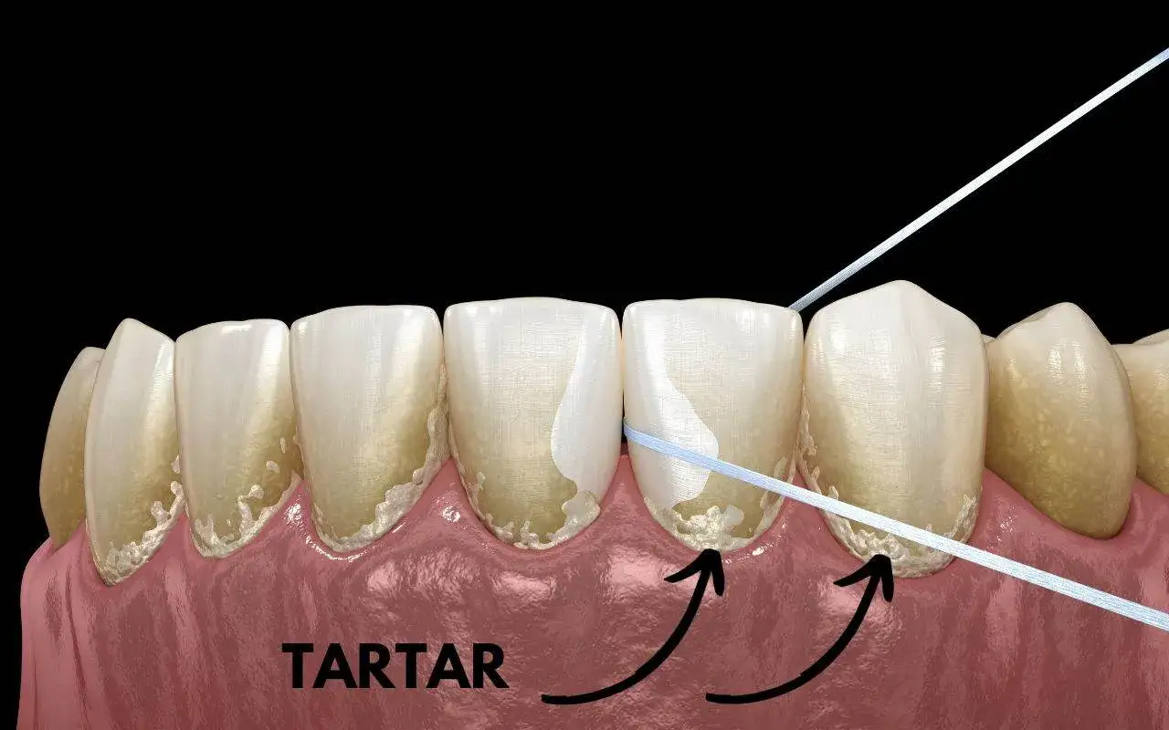 Brązowe kreski na zębach, czyli kamień nazębny, są usuwane nicią dentystyczną.