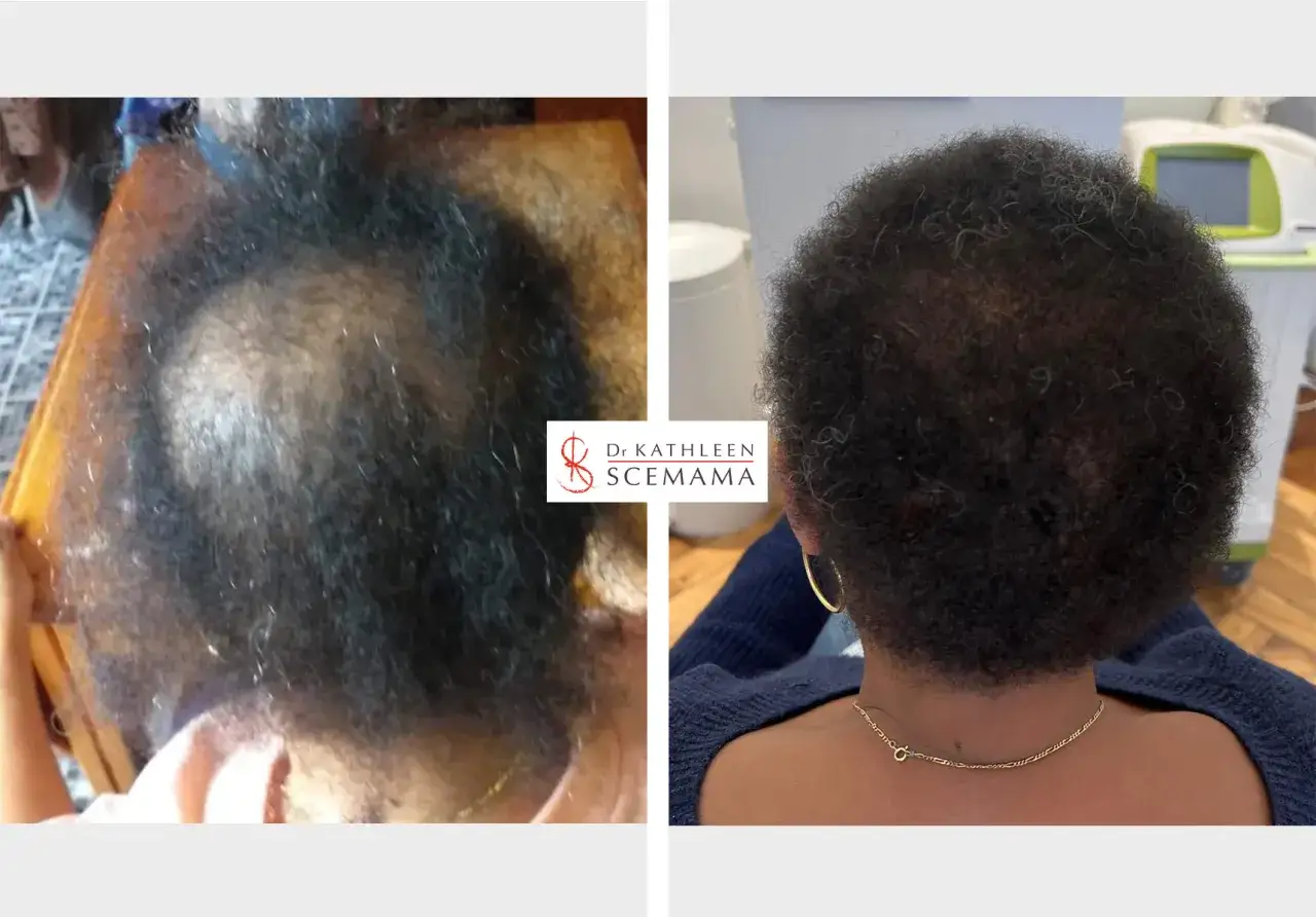 Avant/après : alopécie sur cheveux crépus, montrant une repousse après traitement.