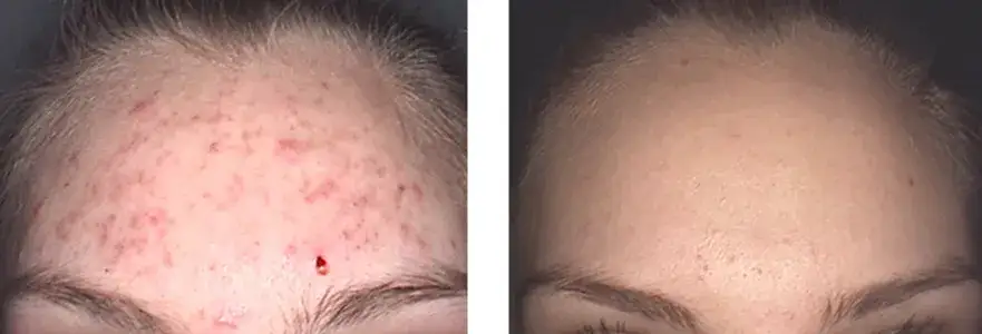 Zdjęcie Jak wygląda twarz po laserze frakcyjnym? Efekty, które zaskakują