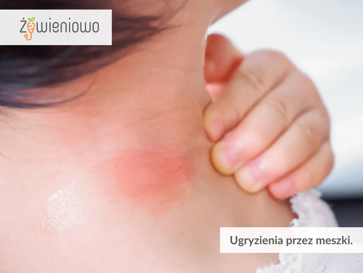 Czerwona, swędząca wysypka na szyi dziecka po ukąszeniu meszki. Dziecko drapie się w bolące miejsce.