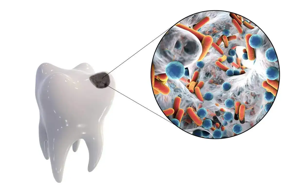 Dente con carie, ingrandimento mostra batteri che causano il dente bucato.