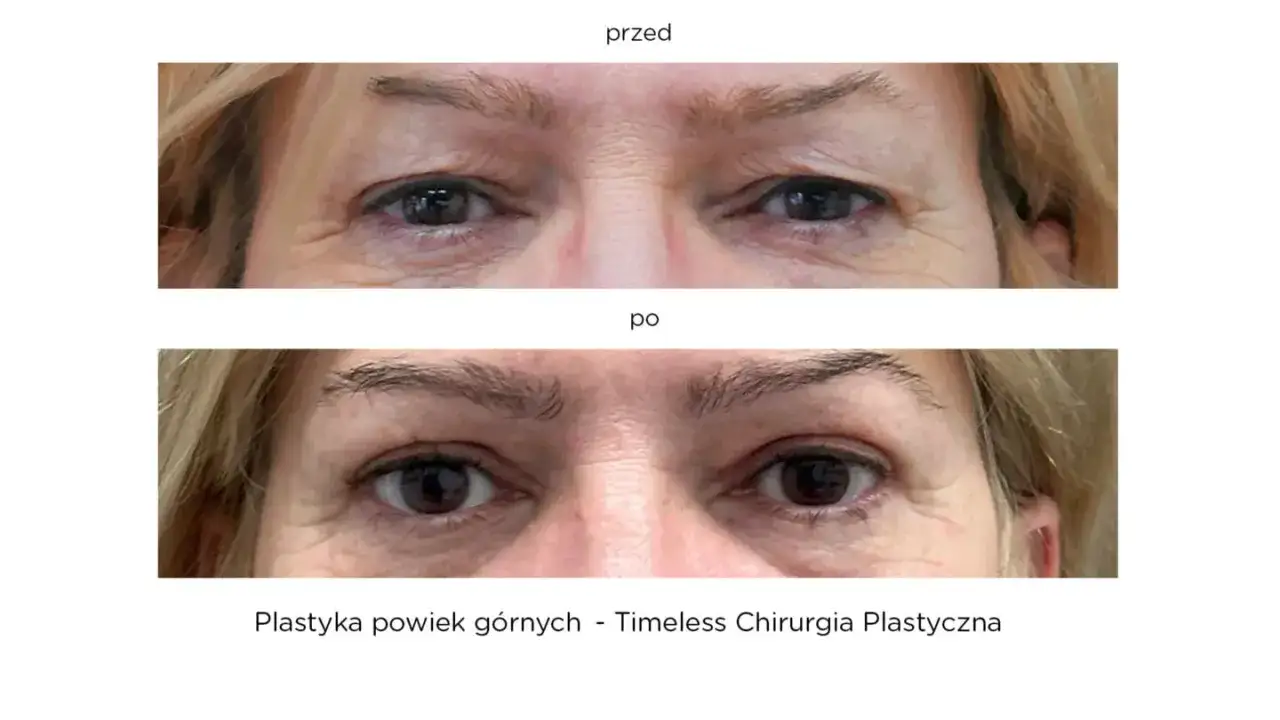 Opadająca powieka przed i po zabiegu. Górna część zdjęcia pokazuje oczy przed korektą, dolna po.