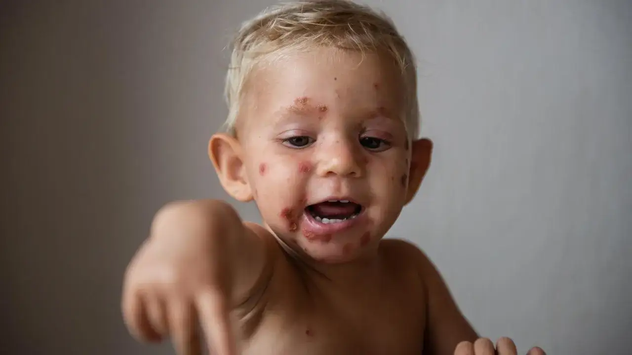 Małe dziecko z wysypką na twarzy, które ulewa 2 godziny po jedzeniu.