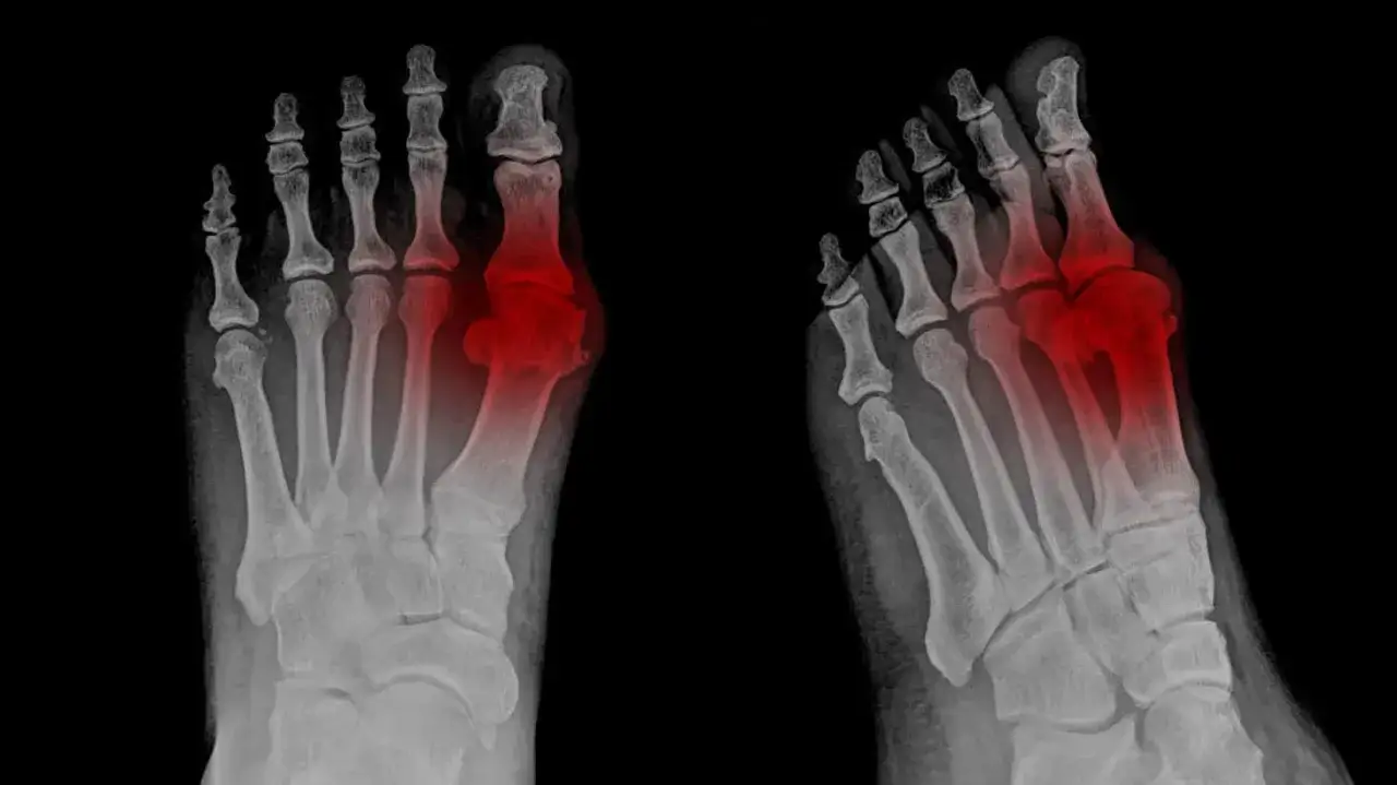 Radiograf&iacute;as de pies con zonas rojas que indican dolor pie lateral interno.
