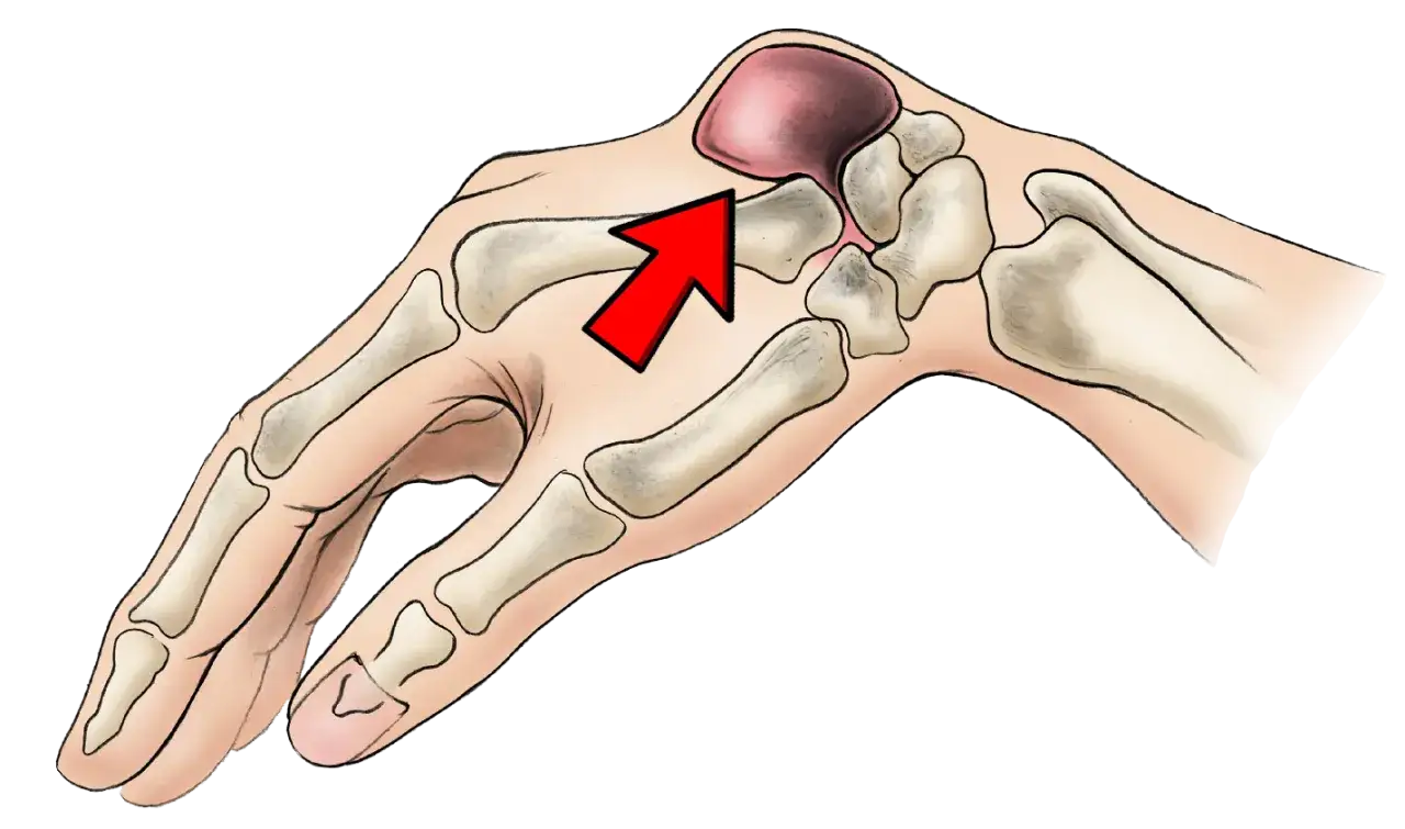 Illustration anatomique montrant un kyste synovial au poignet, comme vu dans des témoignages. Une flèche rouge pointe vers la masse.