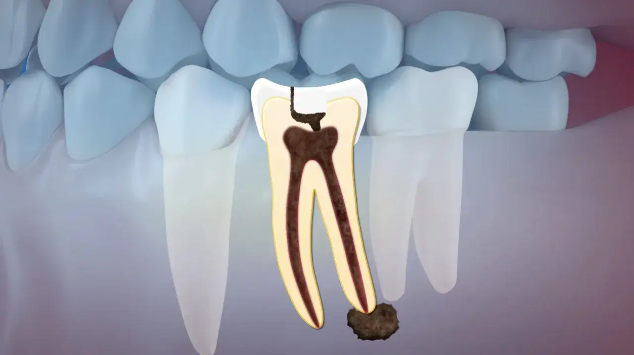 Przekrój zęba jedynki pokazuje martwy ząb z próchnicą i stanem zapalnym u wierzchołka korzenia.
