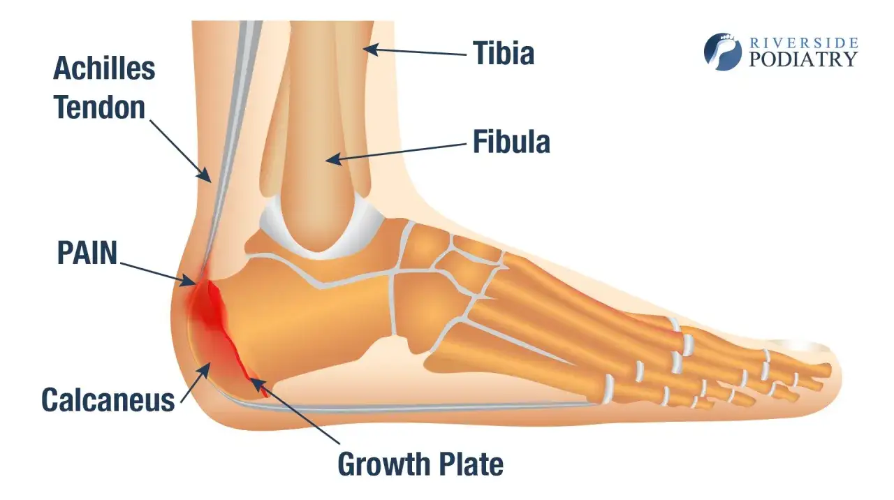Anatomie du pied montrant la douleur au talon due &agrave; la maladie de Sever, affectant la plaque de croissance du calcan&eacute;us et le tendon d'Achille.