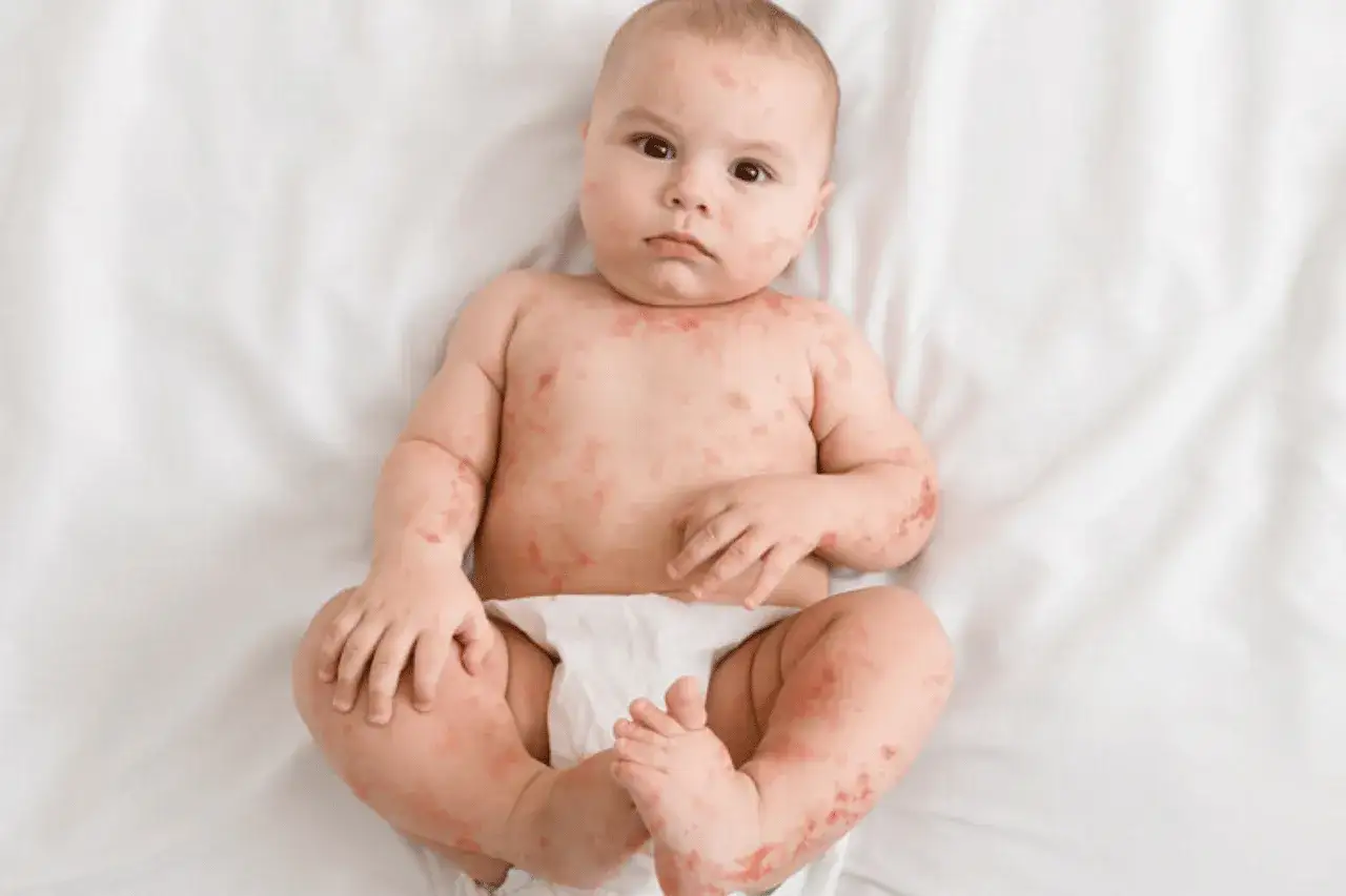Bambino con eruzione cutanea rossa su tutto il corpo, possibile sudamina bambini.